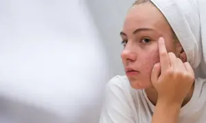 Bolesny pryszcz pod skórą? Pozbądź się go bezpiecznie i bez blizn
