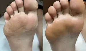 Przed i po: sucha, popękana skóra stóp zamieniona w gładką dzięki profesjonalnemu pedicure frezarkowemu.