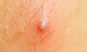Makro zbliżenie na skórę z widoczną, zaczerwienioną krosta w nosie, otoczoną włoskami.