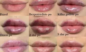 Jak usunąć wąsik? Porównanie metod: ból, koszt, efekty
