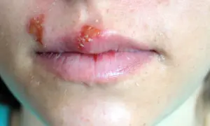 Obrzęk i pęcherzyki na ustach, objawy tego, co na zimno na ustach. Skóra wokół ust jest podrażniona i łuszcząca się.