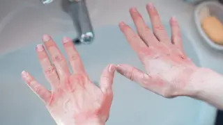 Pękająca skóra na dłoniach, zaczerwieniona i sucha, wymaga troski.