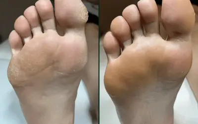 Przed i po: sucha, popękana skóra stóp zamieniona w gładką dzięki profesjonalnemu pedicure frezarkowemu.