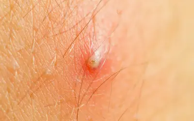 Makro zbliżenie na skórę z widoczną, zaczerwienioną krosta w nosie, otoczoną włoskami.