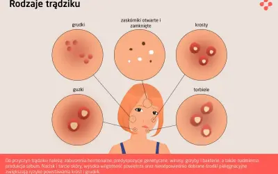 Ilustracja przedstawia różne rodzaje trądziku: grudki, zaskórniki, krosty, guzki i torbiele. Poznaj rodzaje wysypki trądzikowej.