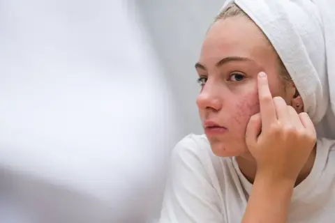 Bolesny pryszcz pod skórą? Pozbądź się go bezpiecznie i bez blizn