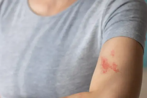 Skóra na ramieniu z zaczerwienionymi, swędzącymi zmianami, które mogą wymagać maści na liszaj.