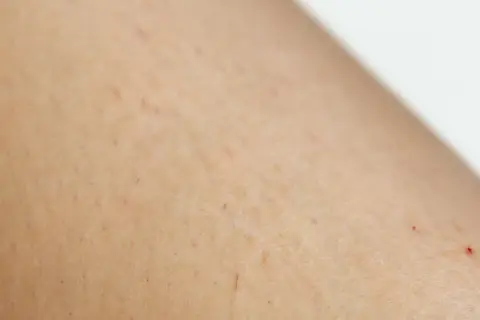 Skóra z drobnymi czerwonymi kropkami i nierównościami, charakterystycznymi dla rogowacenia mieszkowego (keratosis pilaris).