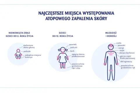 Ilustracja pokazuje miejsca występowania azs u dzieci w różnym wieku: niemowląt, dzieci do 12 lat i młodzieży/dorosłych.