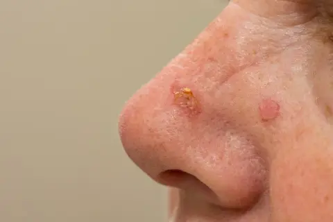 Zmiany skórne na nosie, które mogą wskazywać na różne rodzaje raka skóry.