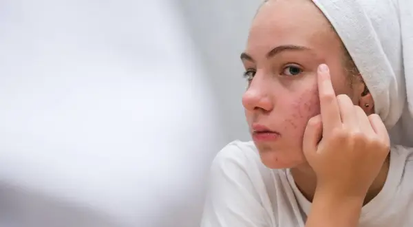Bolesny pryszcz pod skórą? Pozbądź się go bezpiecznie i bez blizn