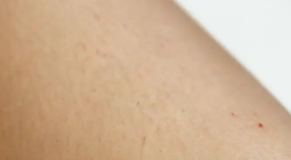Skóra z drobnymi czerwonymi kropkami i nierównościami, charakterystycznymi dla rogowacenia mieszkowego (keratosis pilaris).