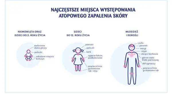 Ilustracja pokazuje miejsca występowania azs u dzieci w różnym wieku: niemowląt, dzieci do 12 lat i młodzieży/dorosłych.