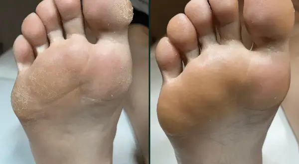 Przed i po: sucha, popękana skóra stóp zamieniona w gładką dzięki profesjonalnemu pedicure frezarkowemu.