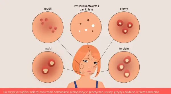 Ilustracja przedstawia różne rodzaje trądziku: grudki, zaskórniki, krosty, guzki i torbiele. Poznaj rodzaje wysypki trądzikowej.