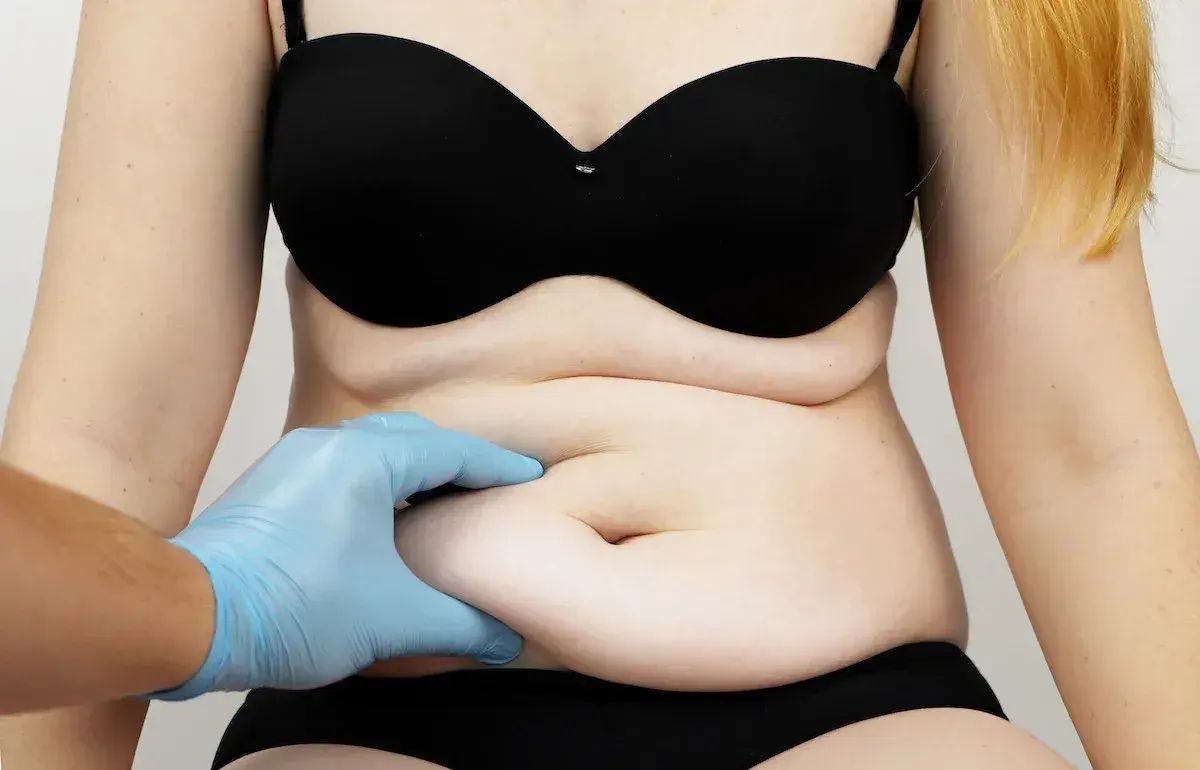 Liposukcja: Jak bezpiecznie wymodelować sylwetkę? Pełny przewodnik