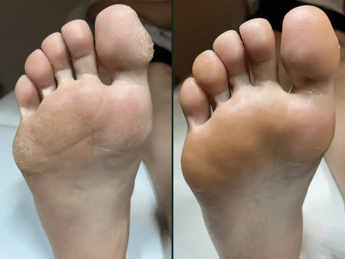 Przed i po: sucha, popękana skóra stóp zamieniona w gładką dzięki profesjonalnemu pedicure frezarkowemu.