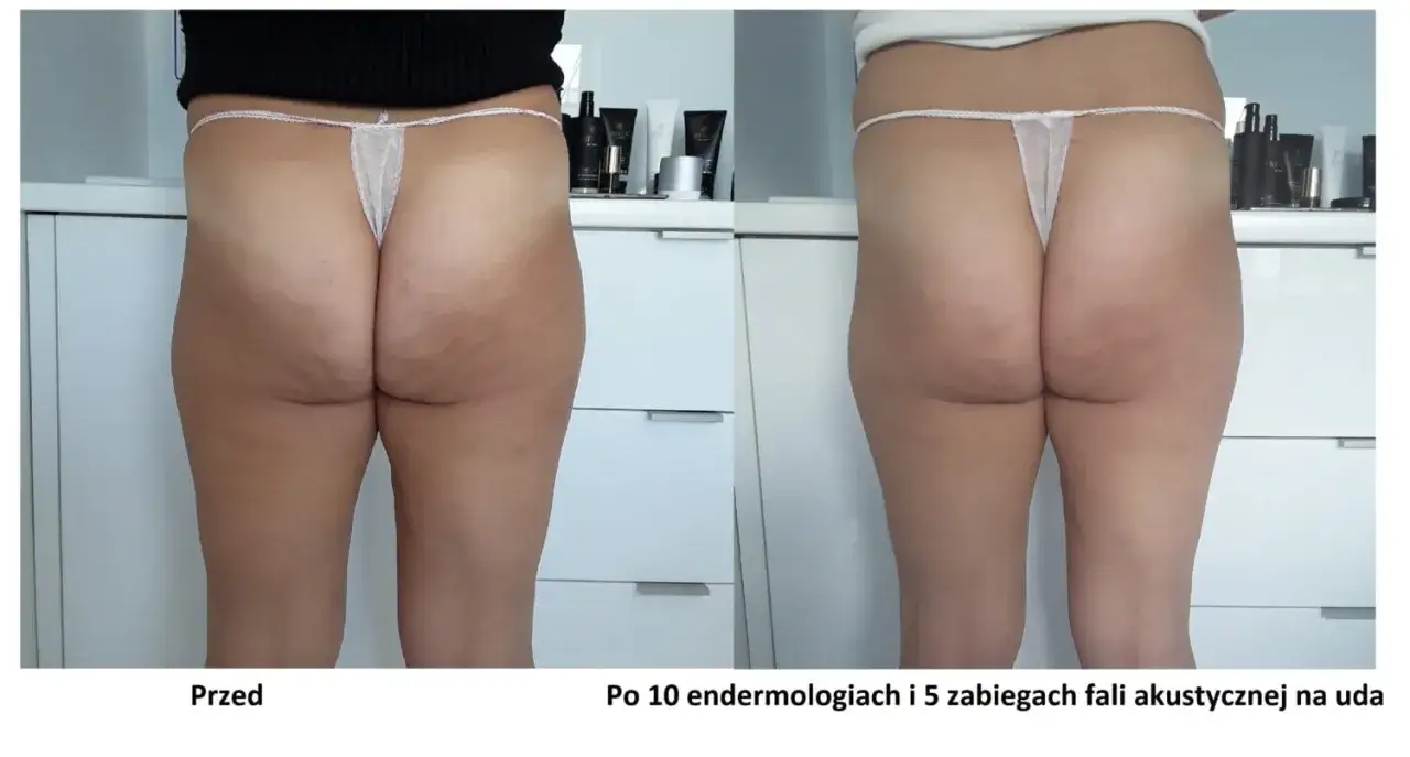 profesjonalne zabiegi na cellulit efekty