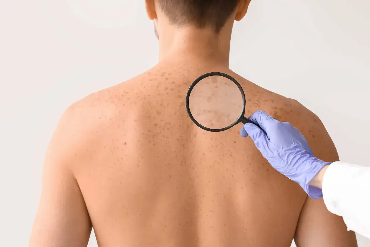 Dermatolog badający skórę pleców