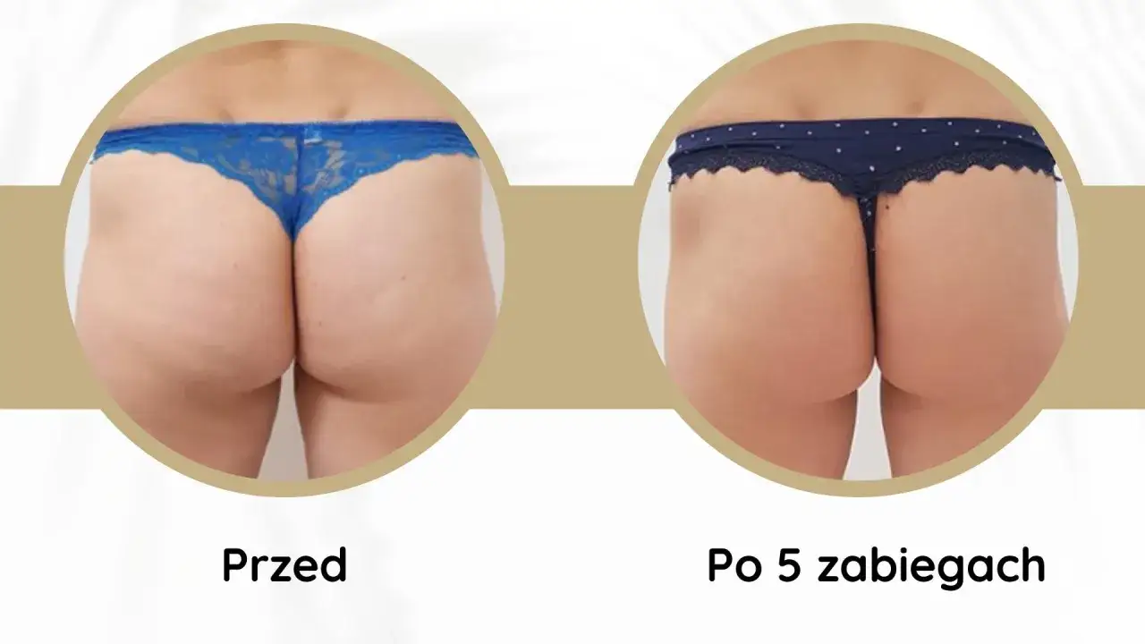 Endermologia ciała i twarzy por&oacute;wnanie