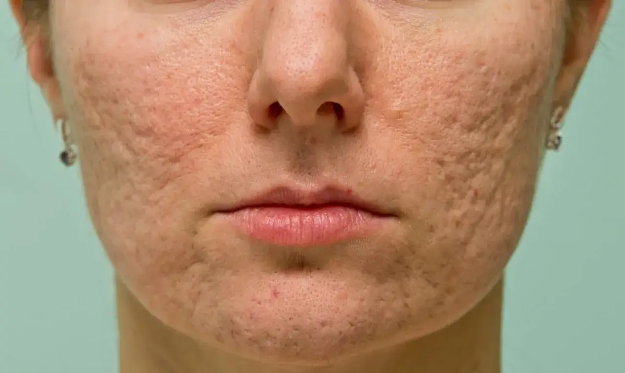 zabiegi na przebarwienia po trądziku laser peeling
