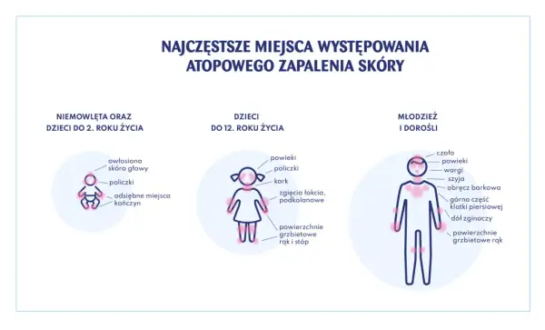 Ilustracja pokazuje miejsca występowania azs u dzieci w różnym wieku: niemowląt, dzieci do 12 lat i młodzieży/dorosłych.