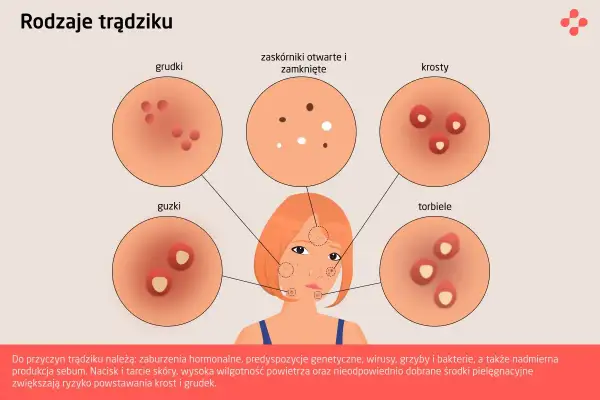 Ilustracja przedstawia różne rodzaje trądziku: grudki, zaskórniki, krosty, guzki i torbiele. Poznaj rodzaje wysypki trądzikowej.
