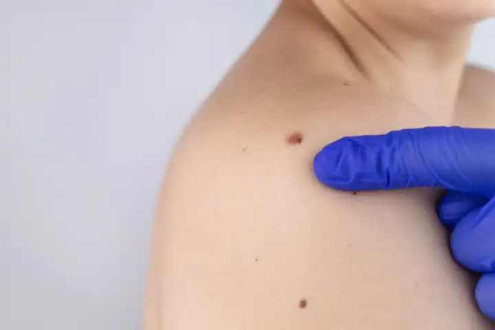Rodzaje pieprzyków i kiedy wymagają kontroli